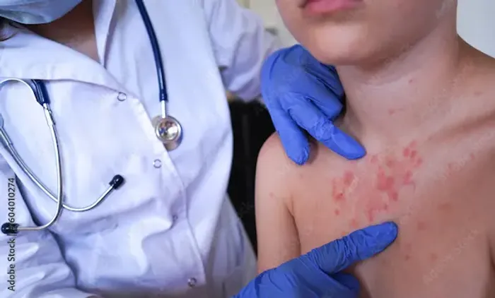 Chickenpox and Monkeypox: Key Differences